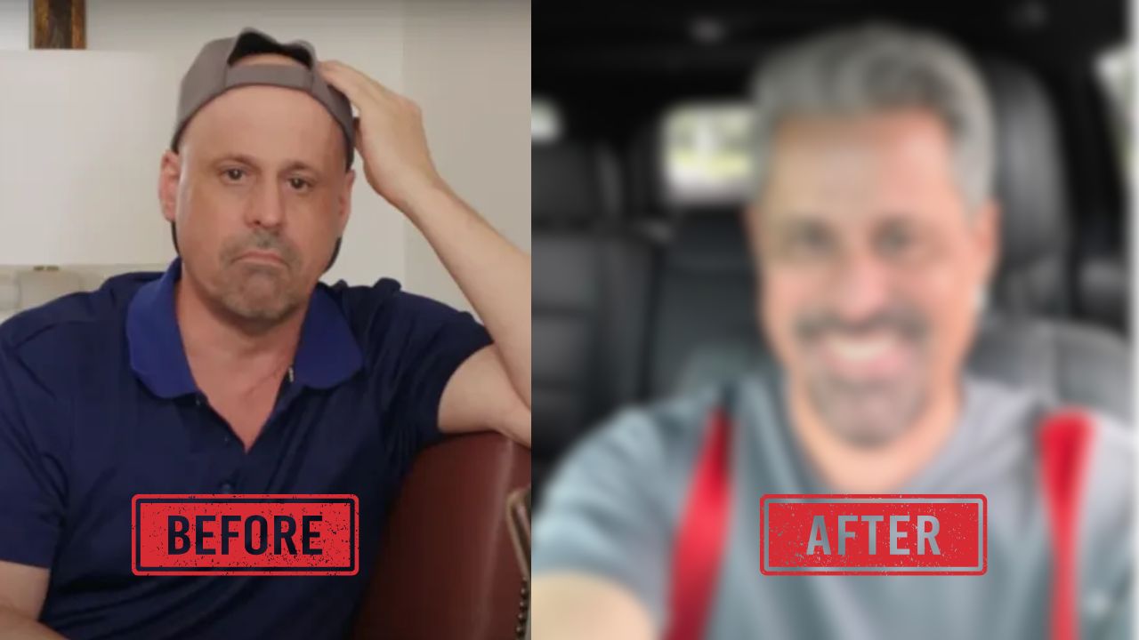 90 DAY FIANCE GINO BEFORE AFTER HAIR TRANSPLANT
