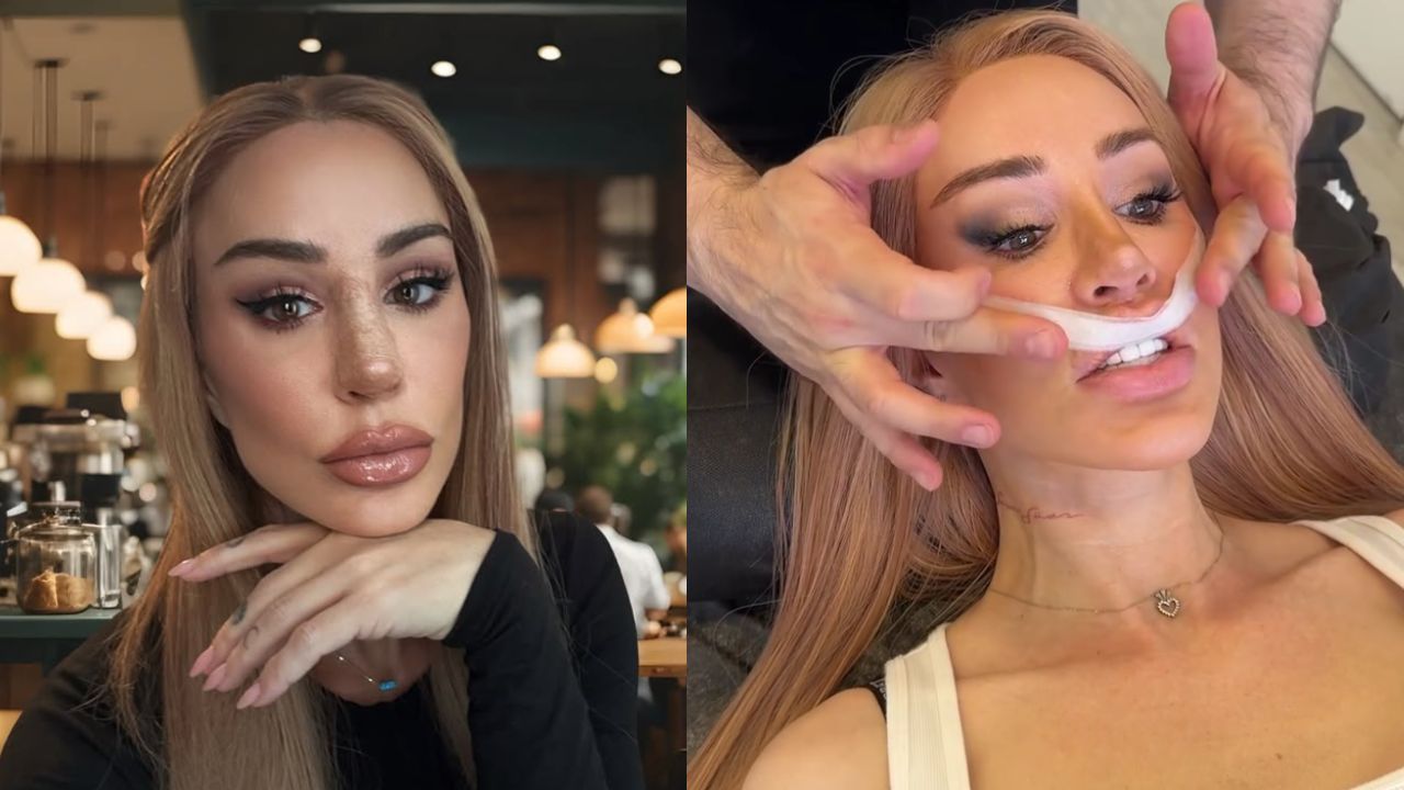 Shekinah lip surgery